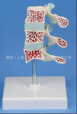 骨質(zhì)疏松癥模型 醫(yī)藥教學(xué)的破冰利器